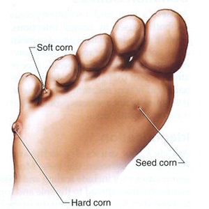 Common Corn Sites